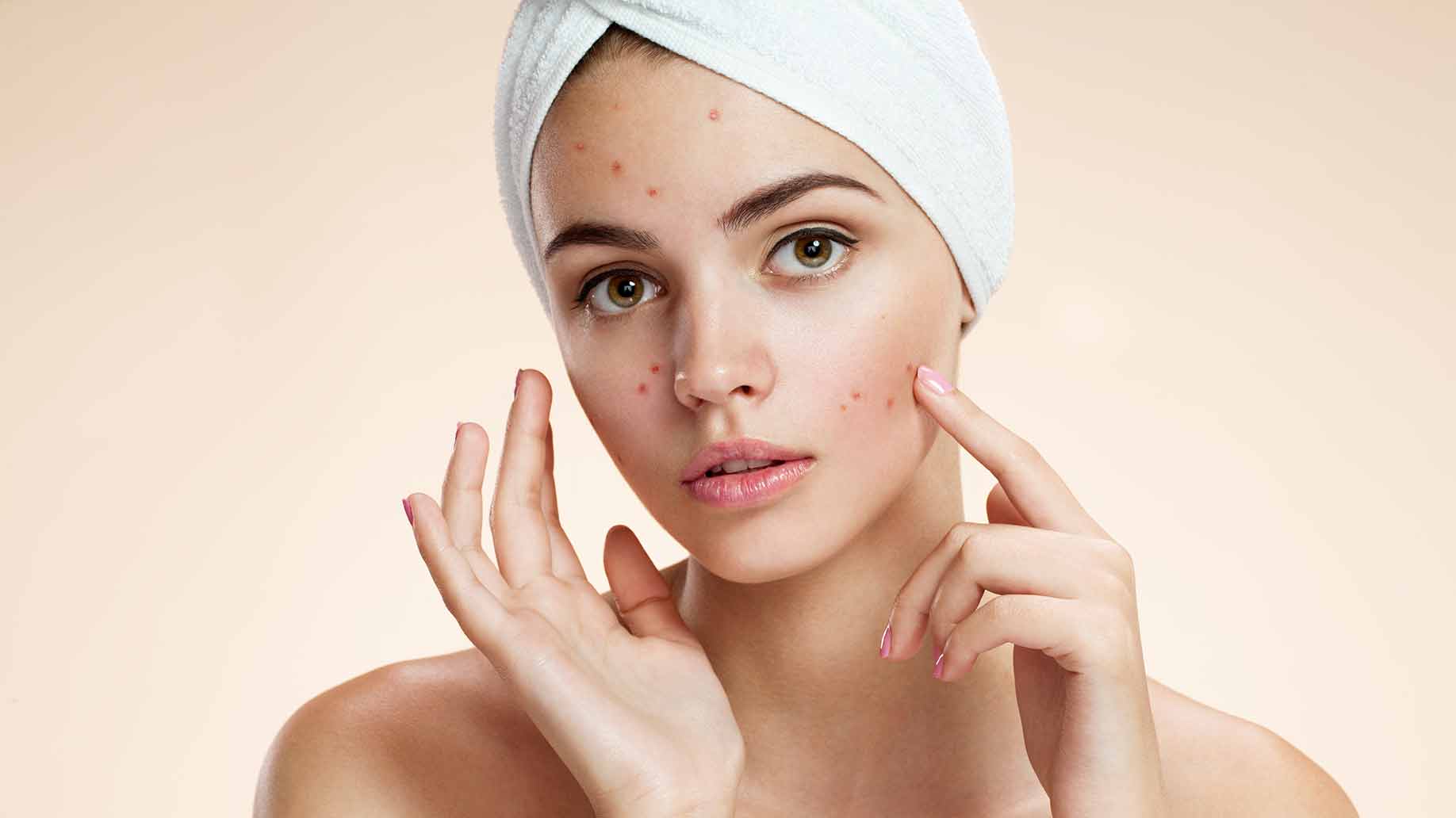 The Diet To Get Rid Of Your Acne