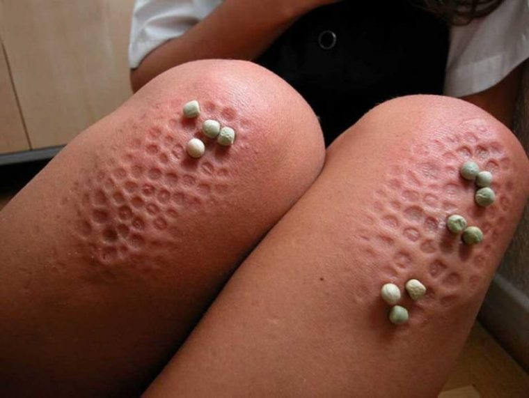 trypophobia skin