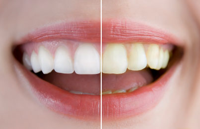 7 Foods That Are Staining Your Teeth